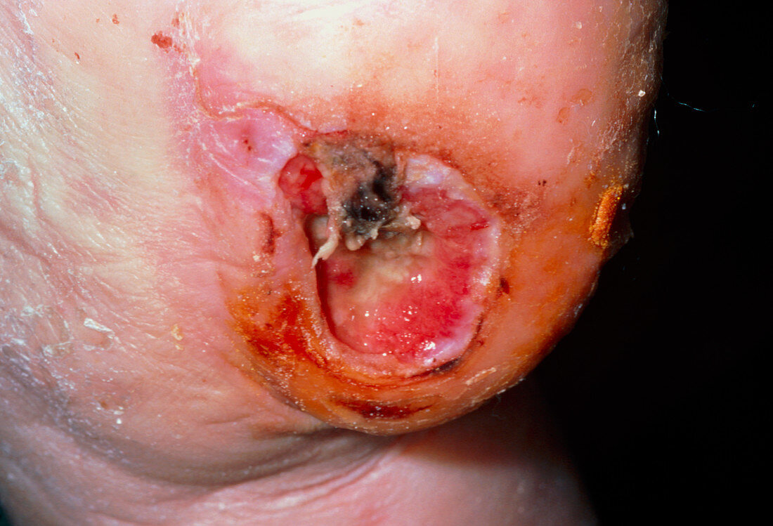 Infected diabetic ulcer on the heel of a foot