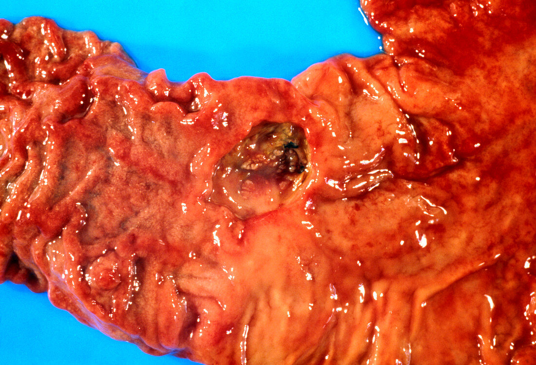 Close-up showing a duodenal ulcer