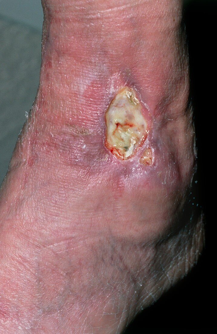 Arterial ulcer caused by war wound to ankle
