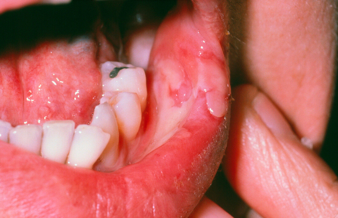 aphthous-ulcer-inside-lower-lip-bild-kaufen-11843495-science-photo