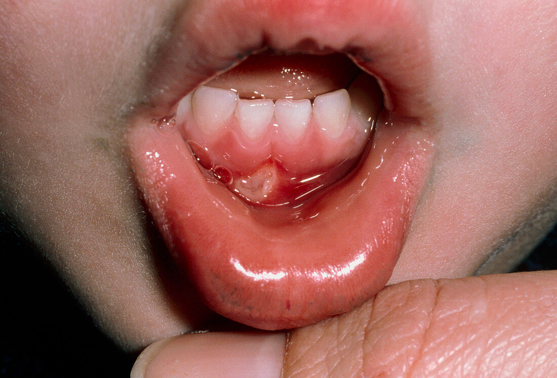 Aphthous ulcer in a child mouth