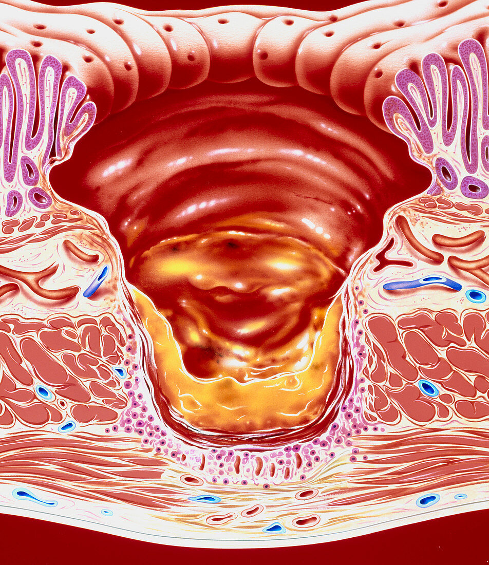 Artwork showing close-up of gastric ulcer