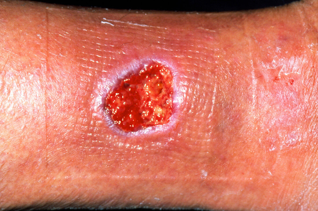 Healing ulcer on a 75 year old woman's leg