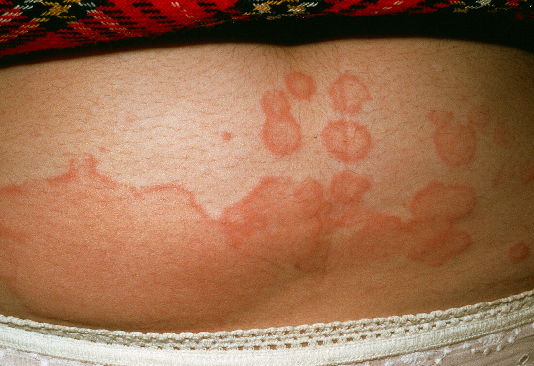 Urticaria rash