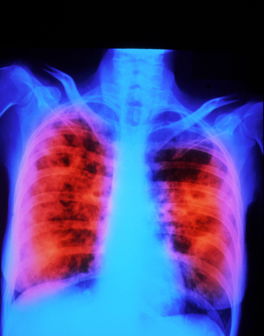 False-colour chest X-ray post-primary tuberculosis