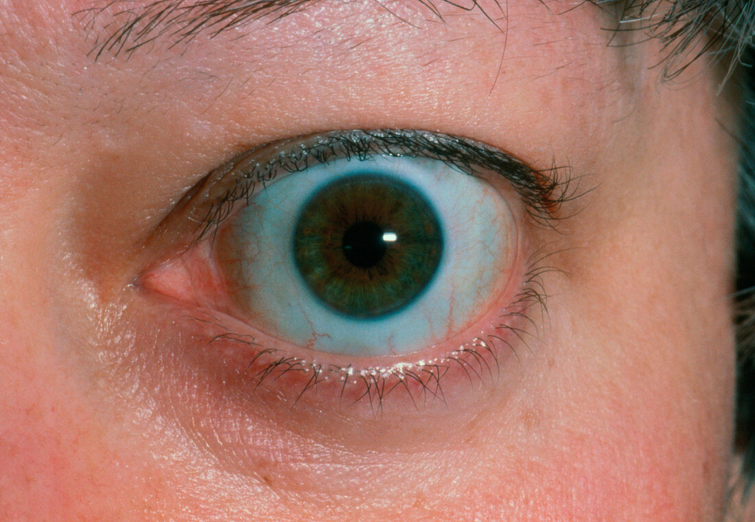 Bulging eye (exophthalmos) due to thyrotoxicosis
