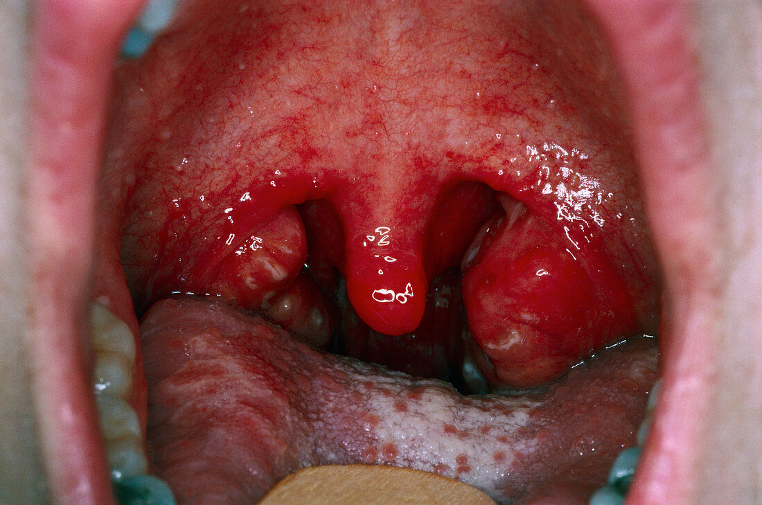 Close-up of throat with tonsillitis