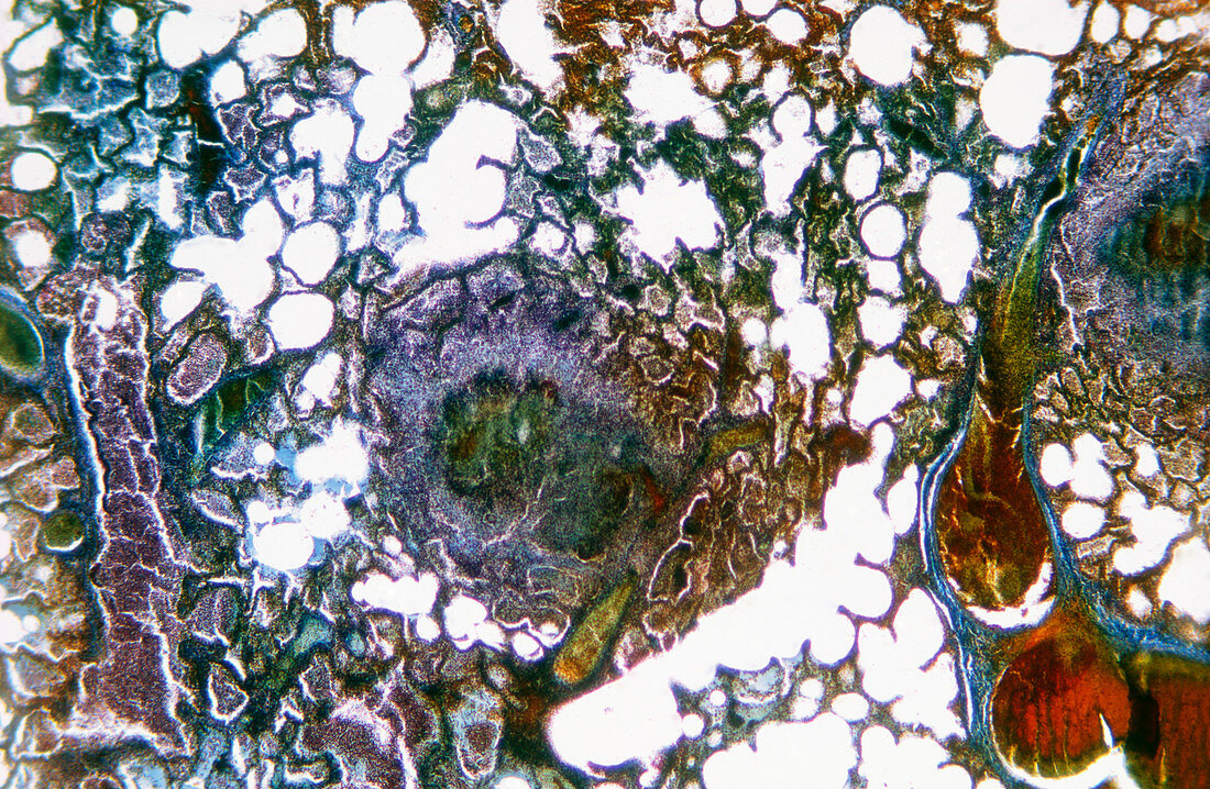 Light micrograph of miliary tuberculosis in lung