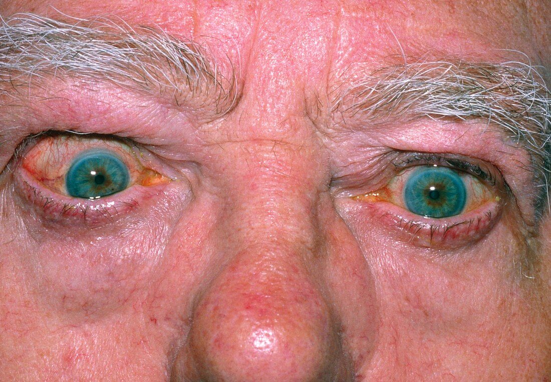 Bulging eye of man with thyrotoxicosis