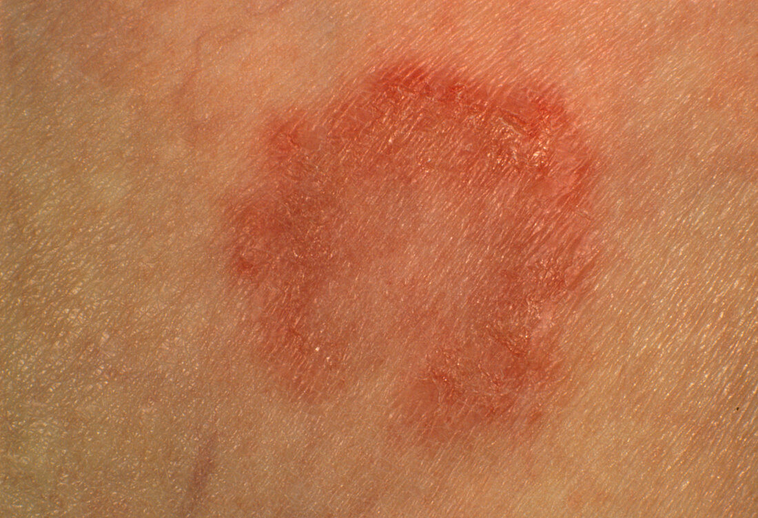 Tinea corporis: ringworm lesion on skin
