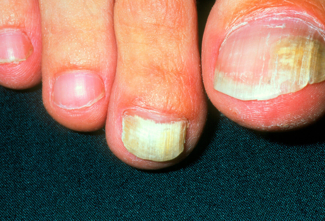 Toenails showing Tinea unguium fungal infections