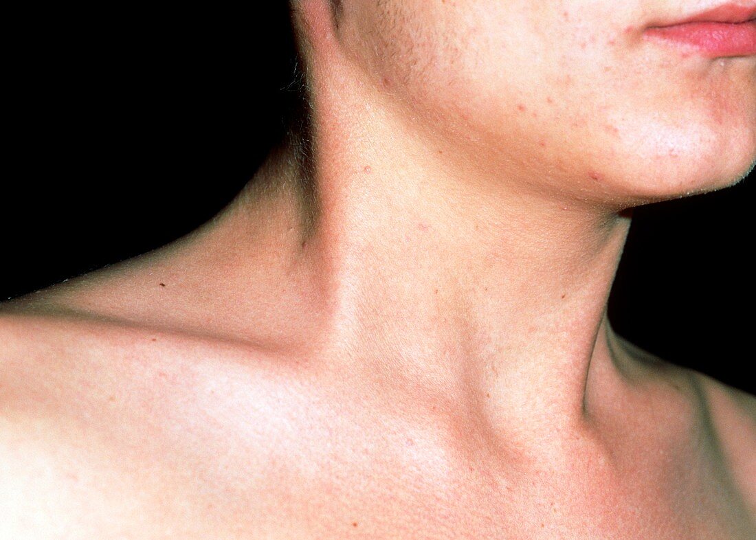 Torticollis in the neck of a 20 year old man