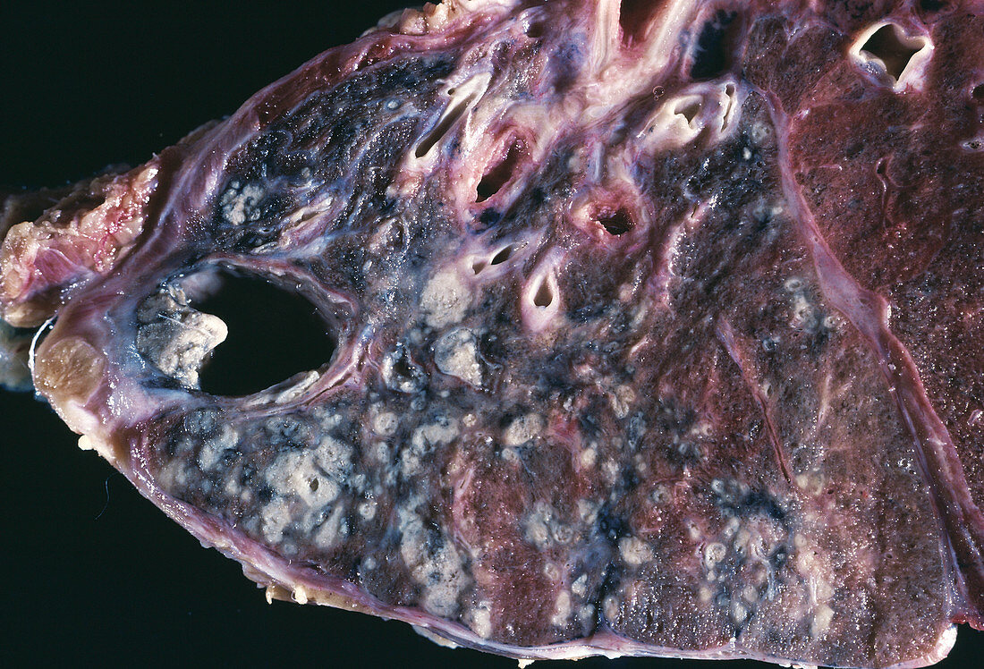 Pulmonary tuberculosis