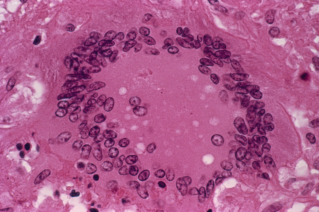 Tuberculosis,light micrograph