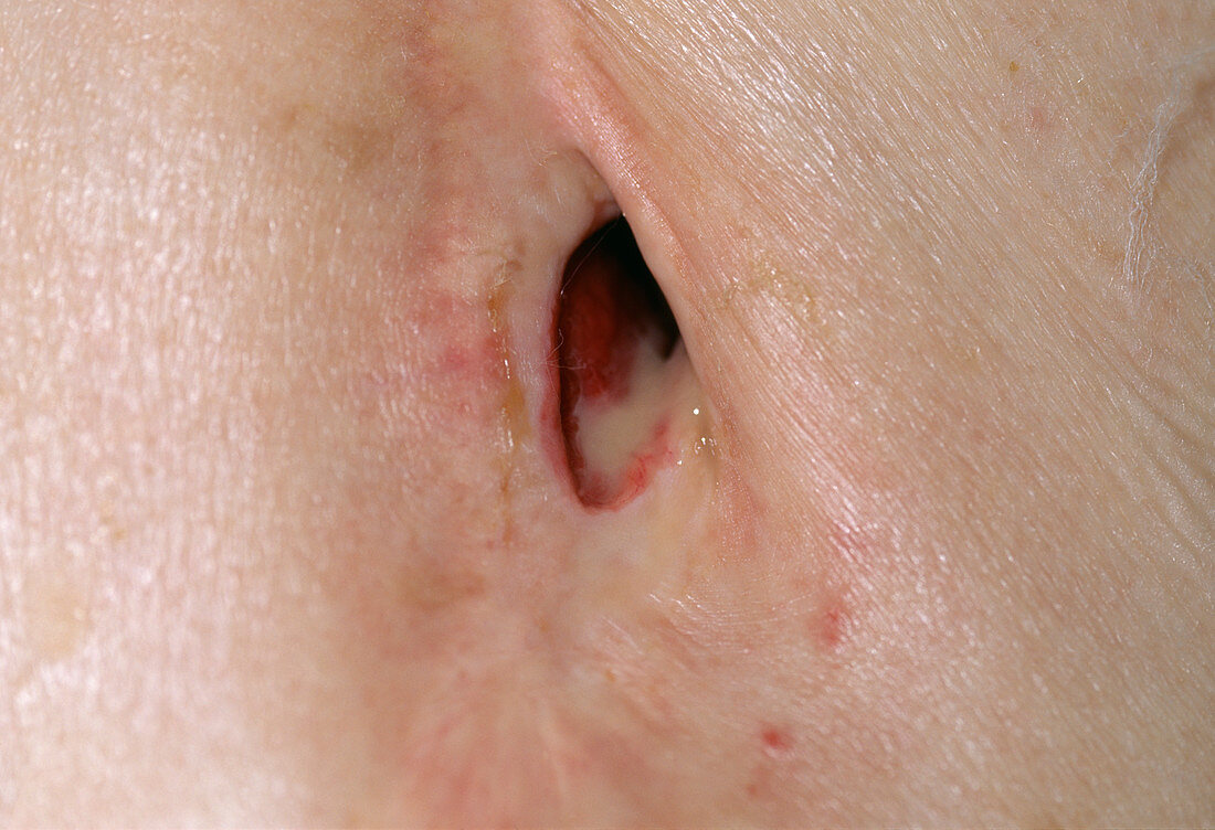 Infected chest fistula