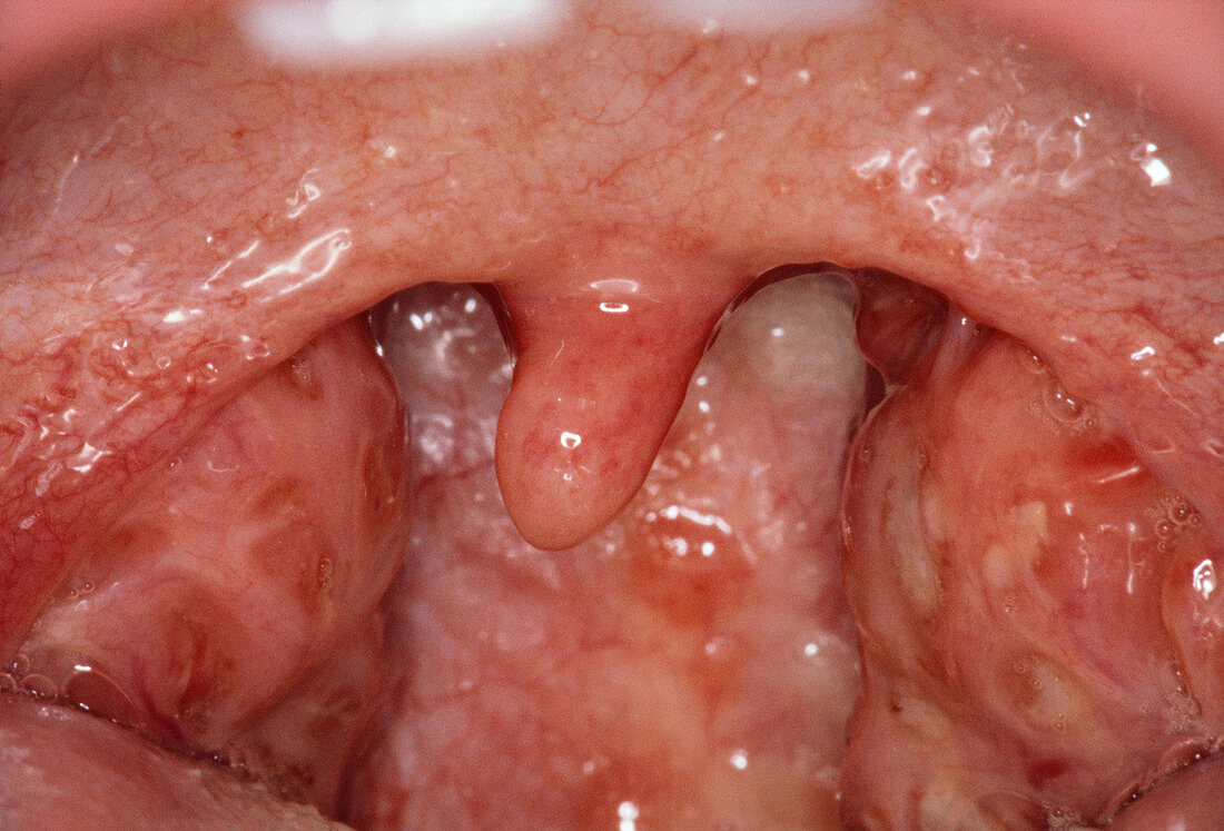 Inflamed tonsils