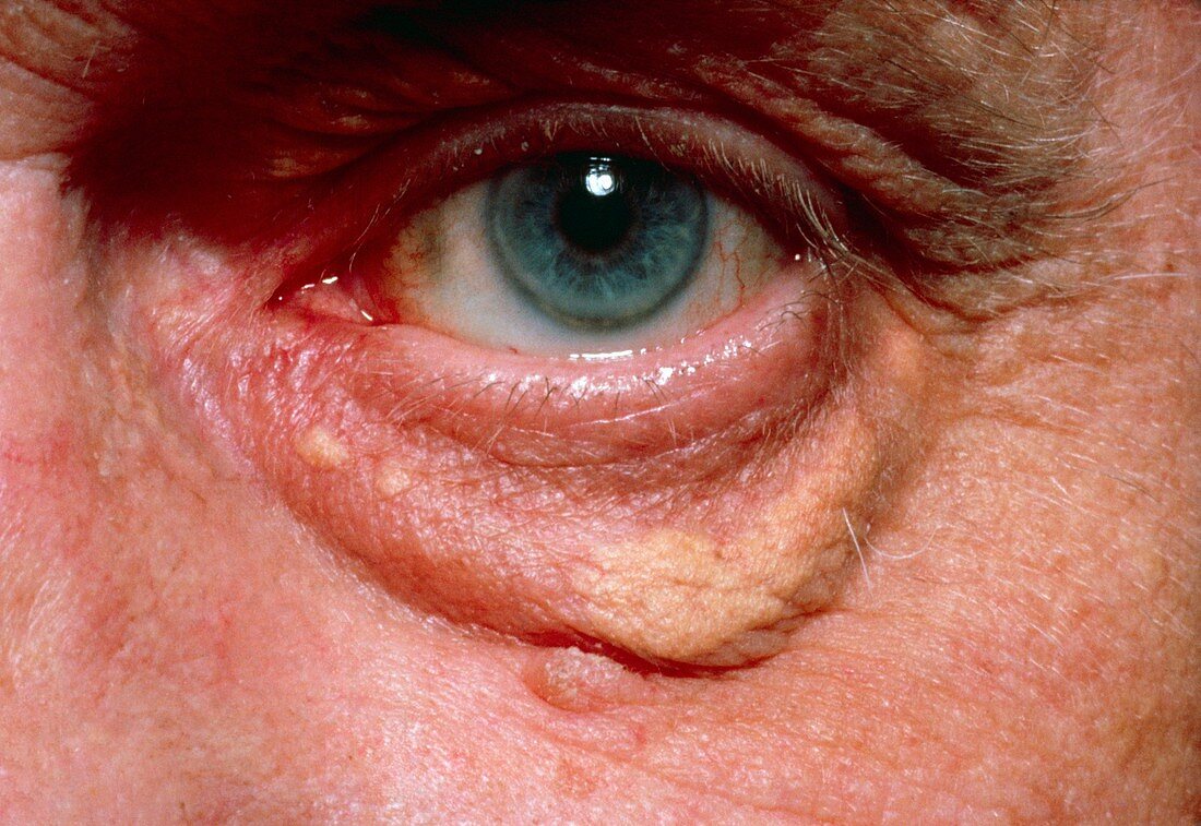 Yellowish swelling of lower eyelid