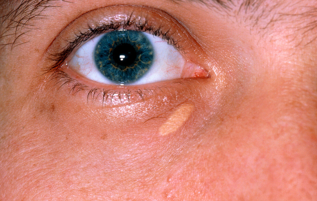 Xanthelasma deposit on lower eyelid