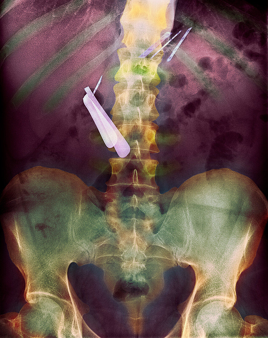 Swallowed razor and razor blades,X-ray