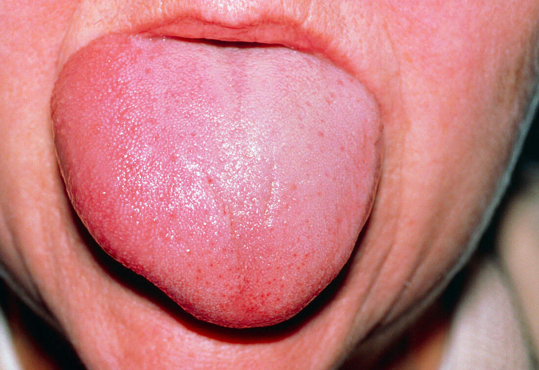 Angioedema on tongue