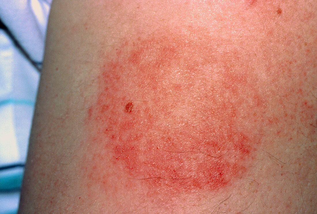 Skin-patch allergy to nicotine