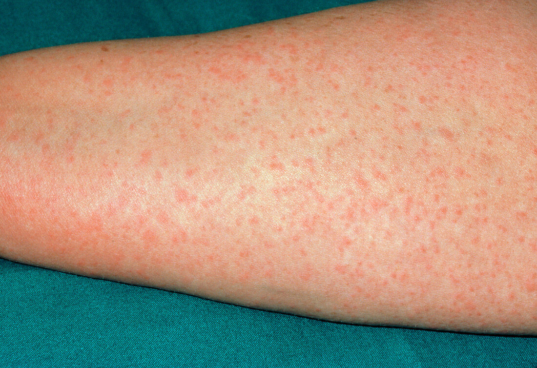 Penicillin allergy on the forearm
