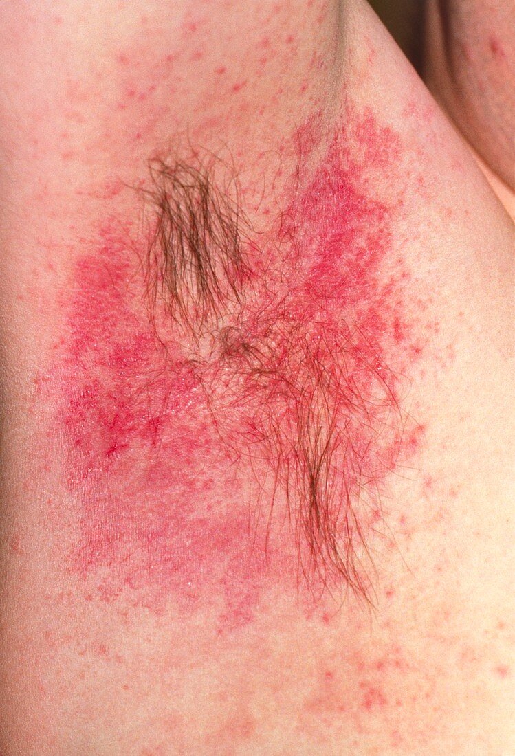 Hypersensitivity reaction to deodorant in armpit
