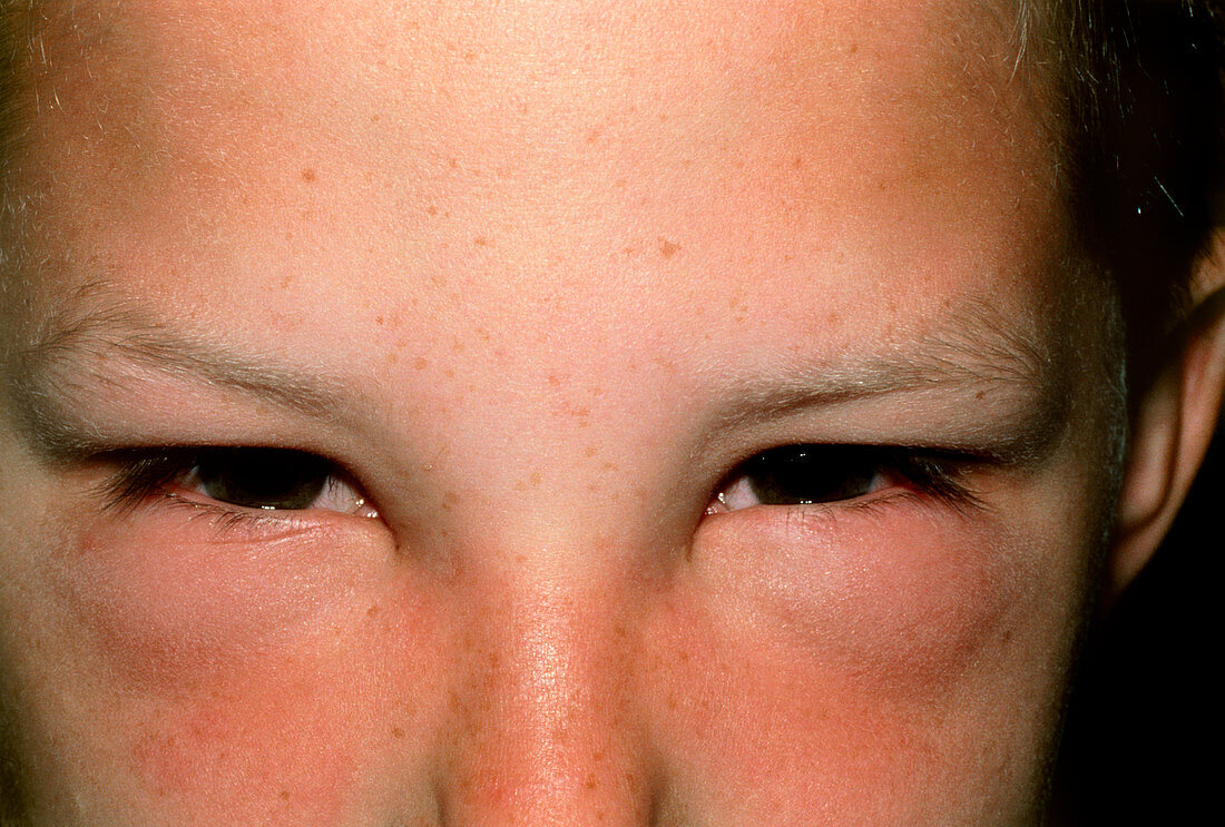 Hay fever: child's face with swollen eyes