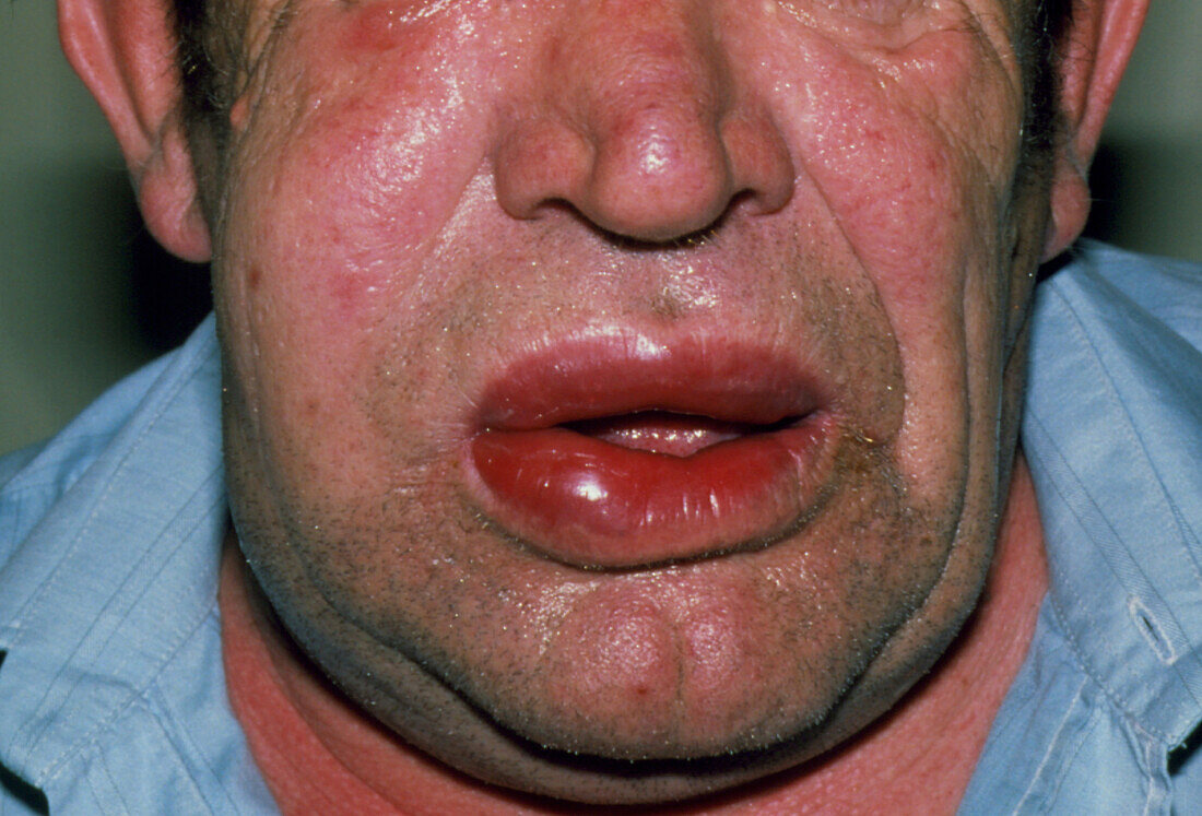 Angioedema of lips due to allergic reaction