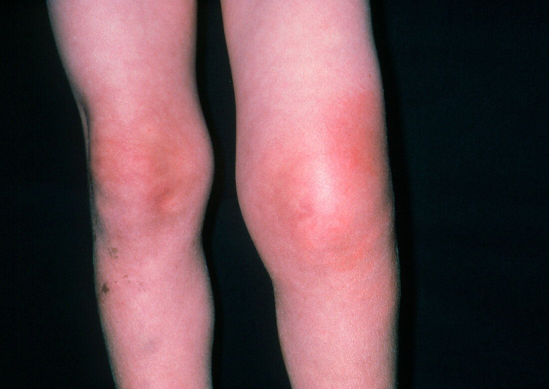 Child's swollen knee due to a wasp sting