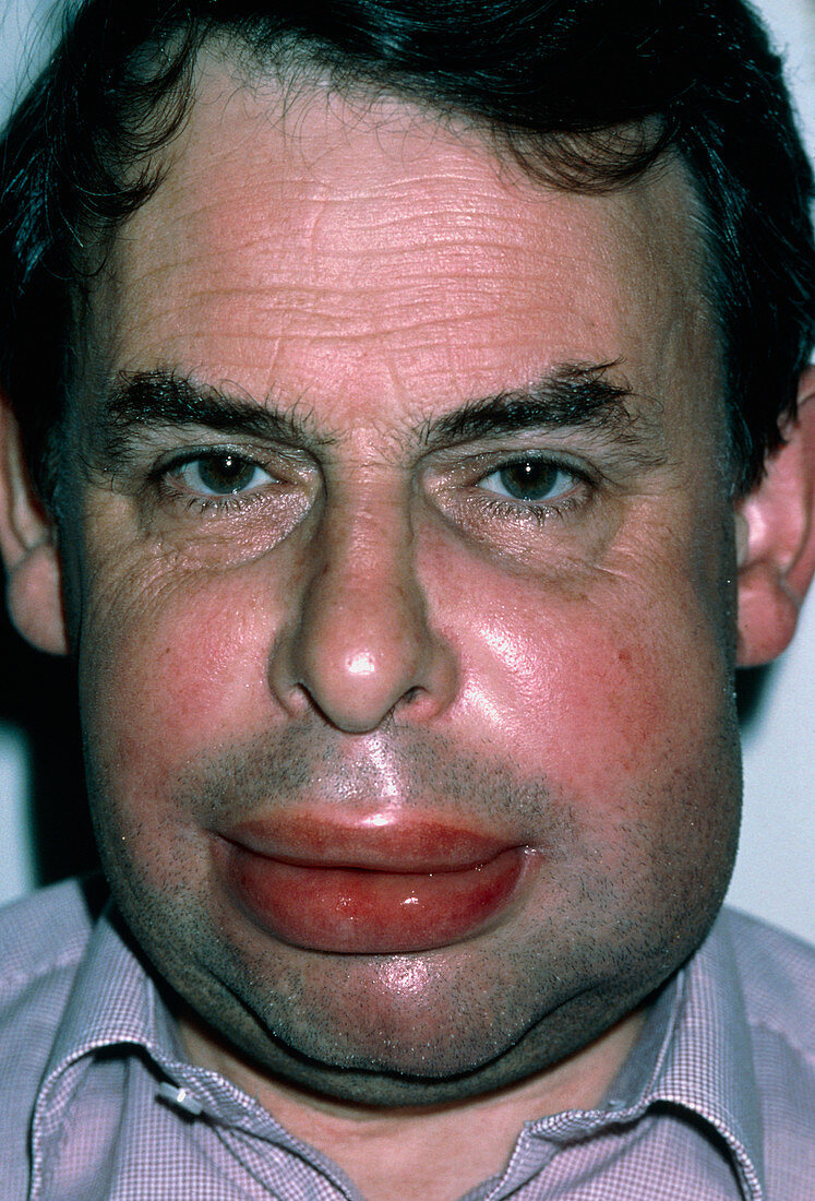 Angioedema of face in 50-year-old man