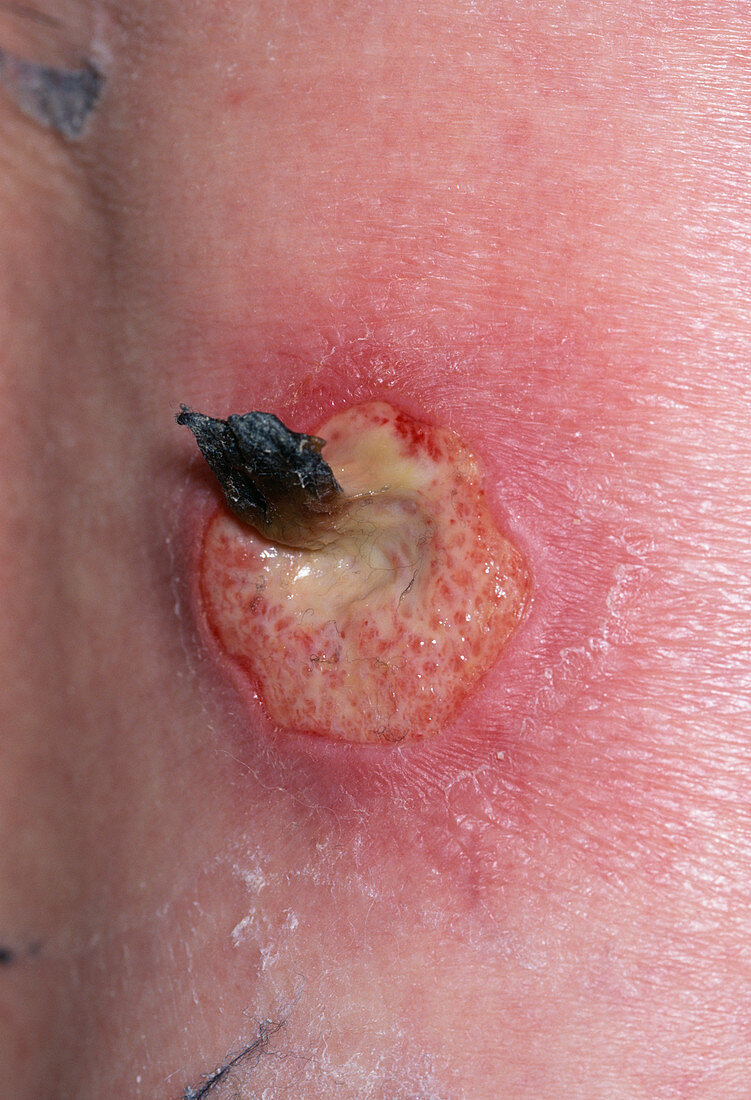 Infected ulcer