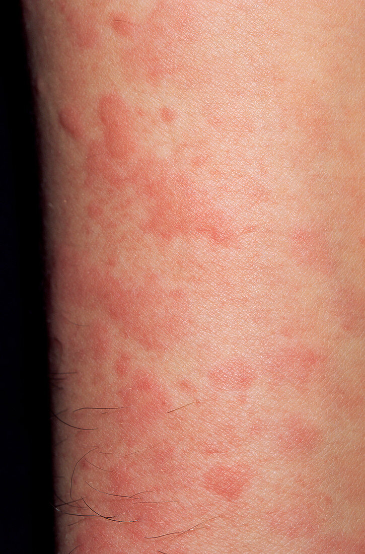 Urticaria reaction