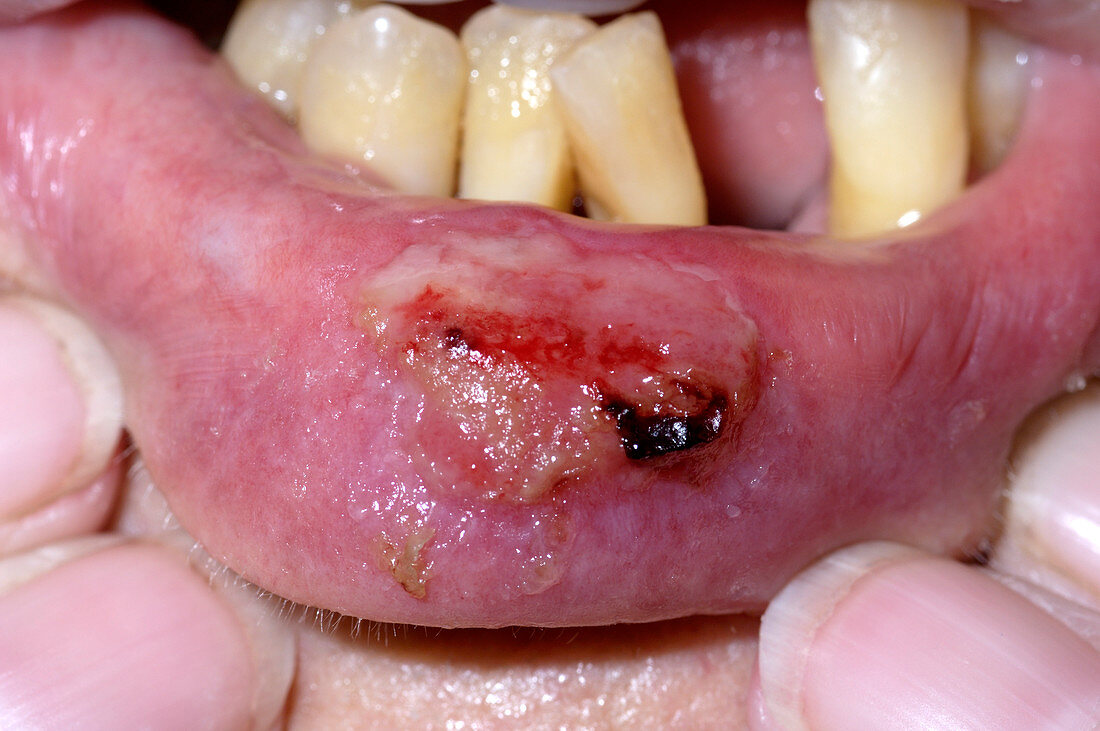 Aphthouse ulcer on the lip
