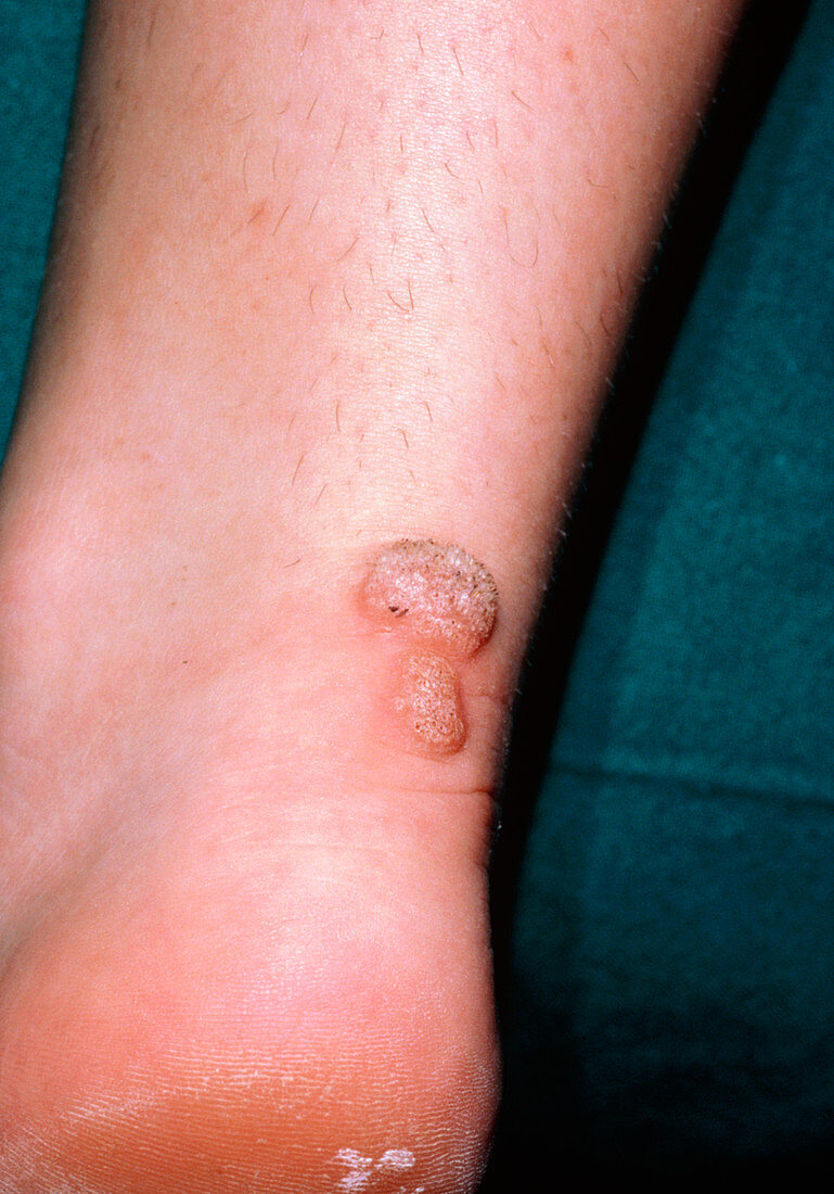 Warts on a person's heel