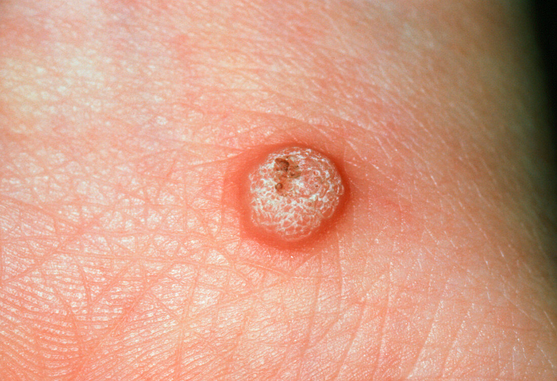 Close-up of a verruca (wart)