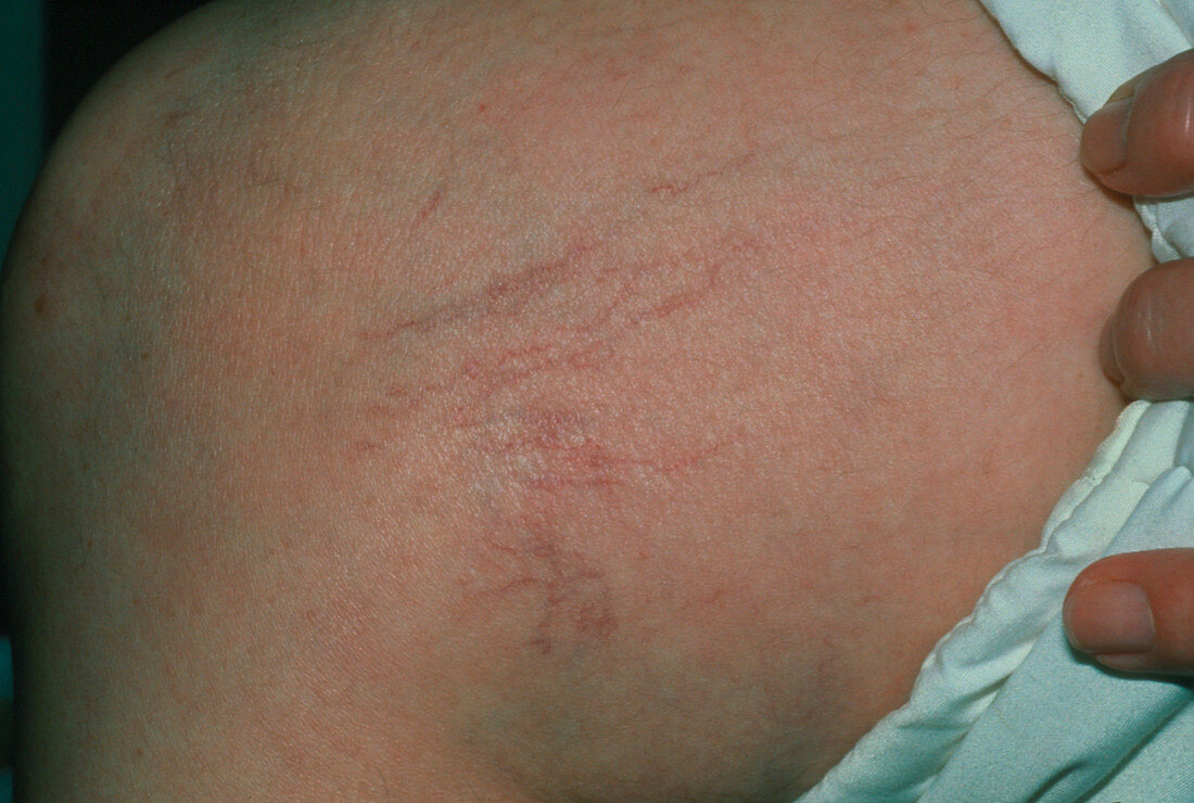 Capillary varices on a woman's leg