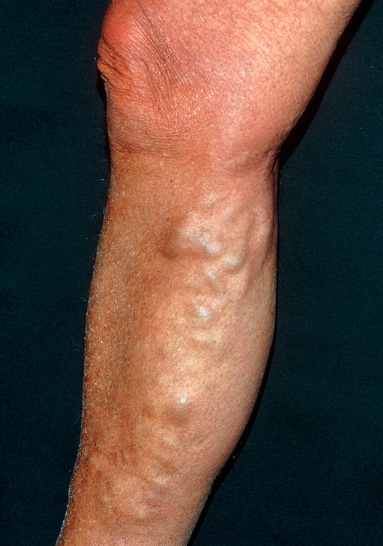 Varicose veins affecting the leg of an elderly man