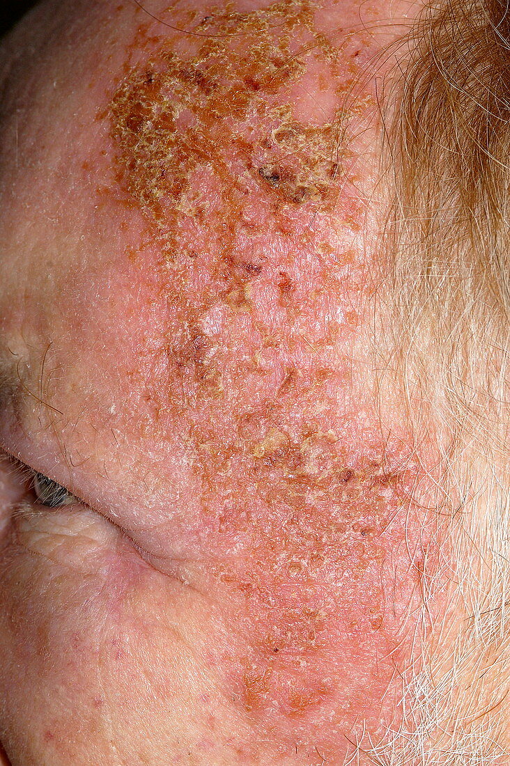 Allergic skin reaction