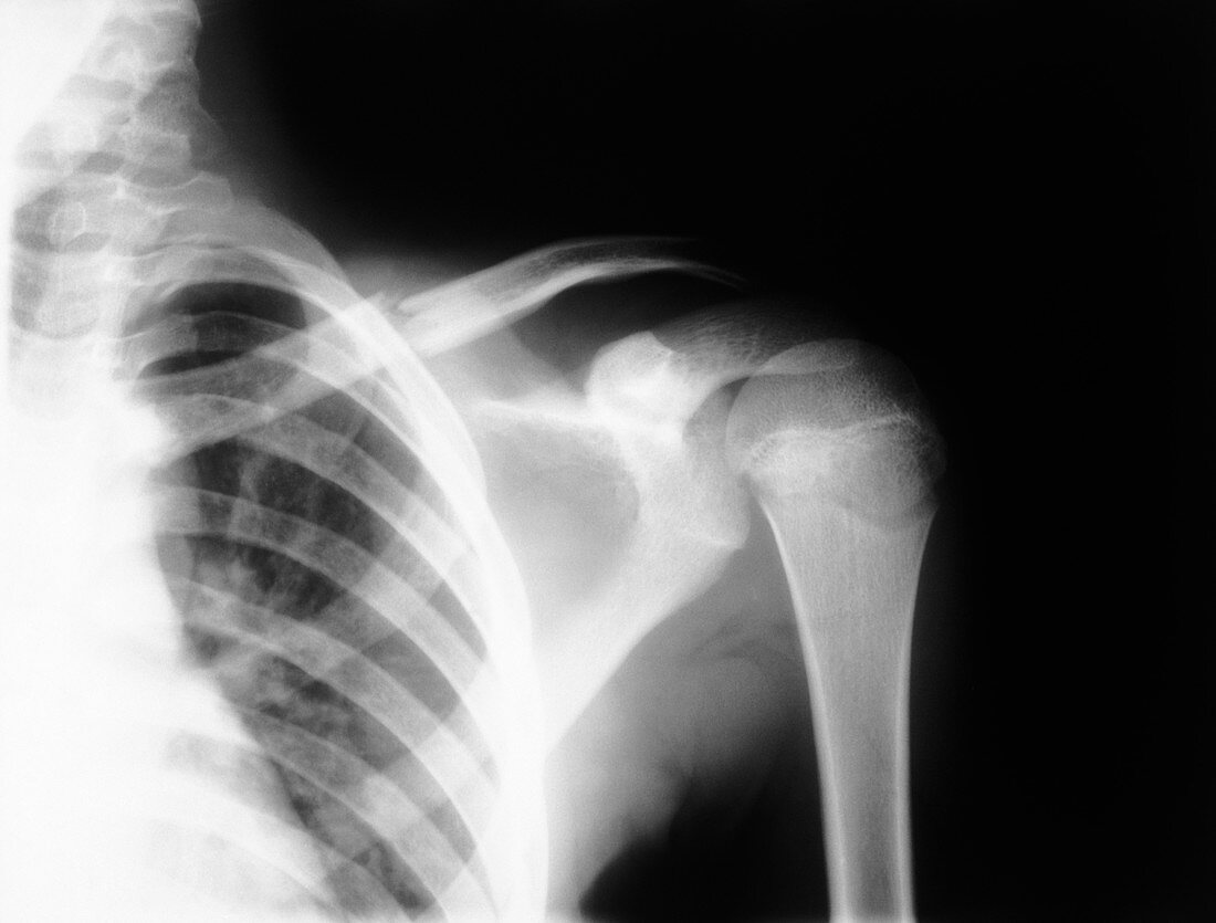 X-ray photo of upper chest & shoulder joint