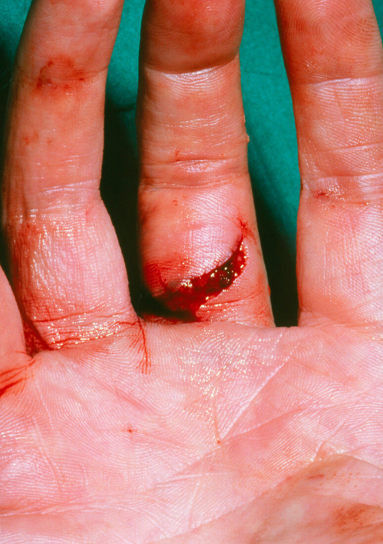 Hand showing severe laceration to a finger