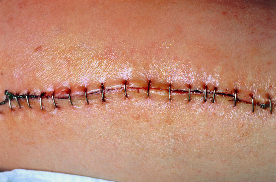 Metal staples closing a wound on a man's thigh