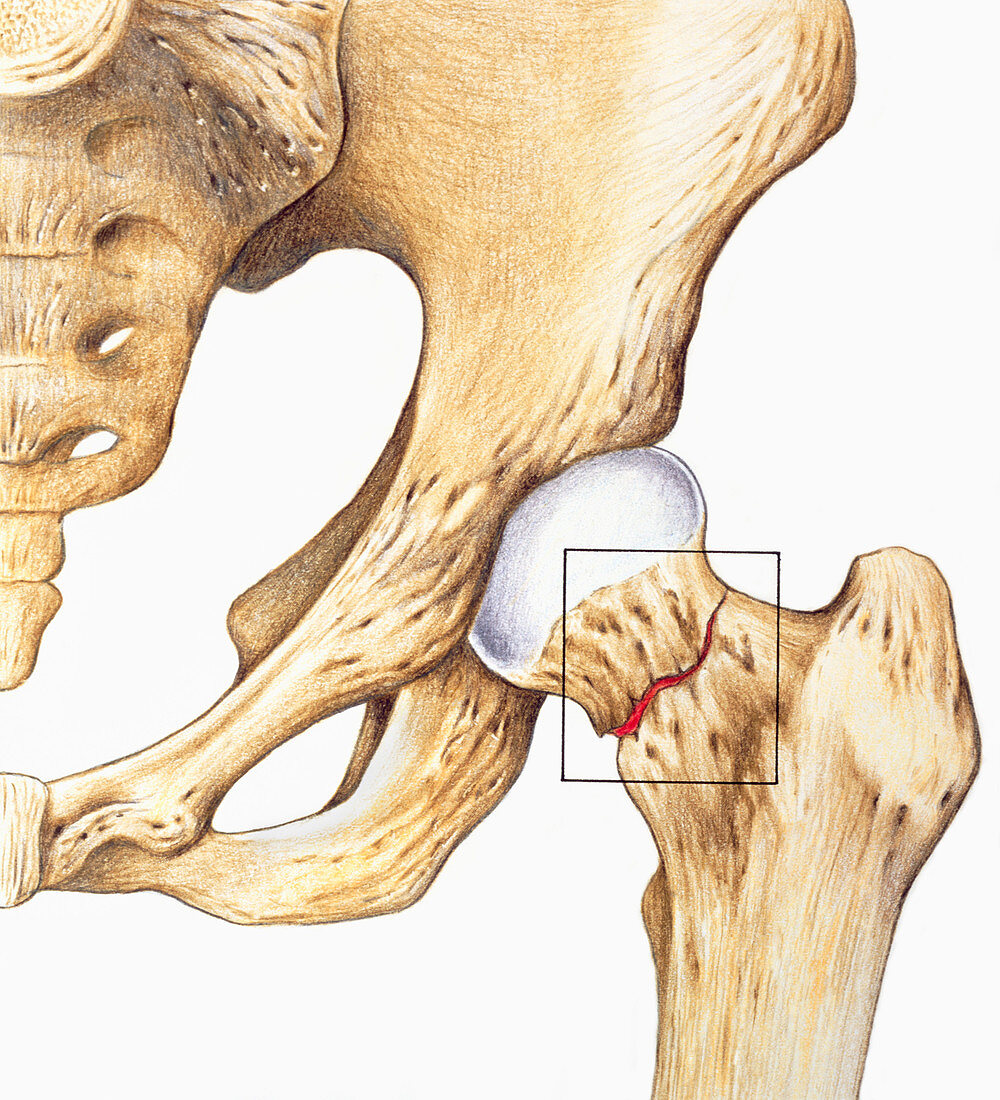 Illustration of a fractured femur