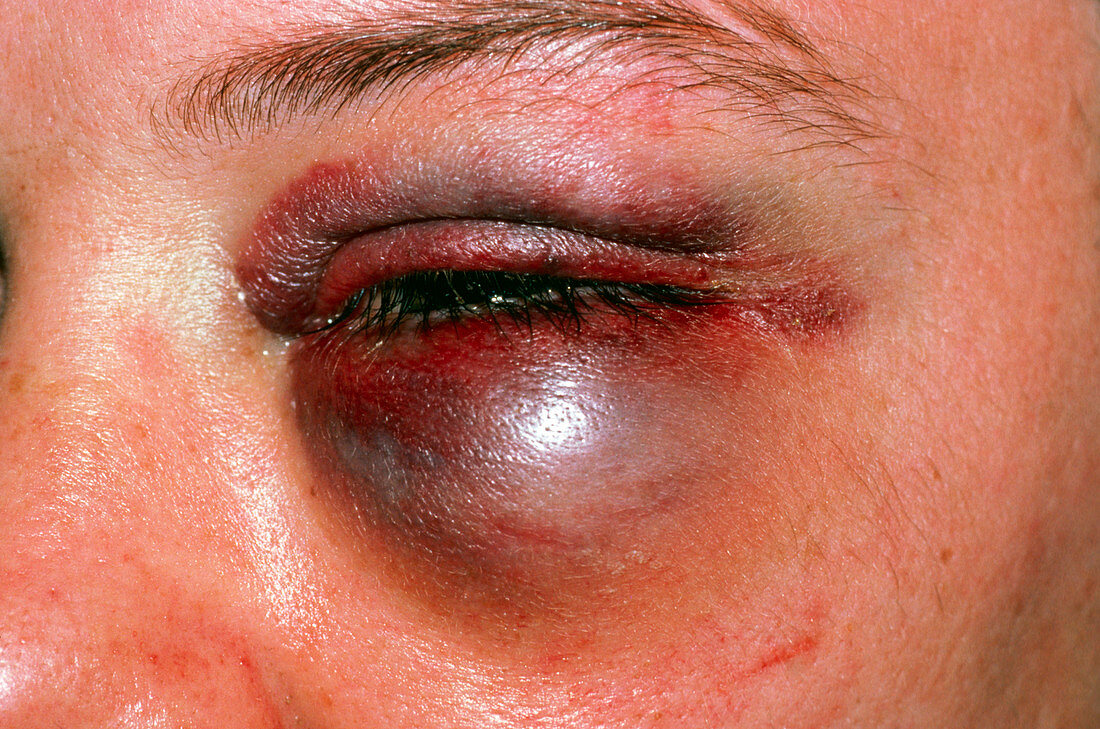 Man suffering from a black eye