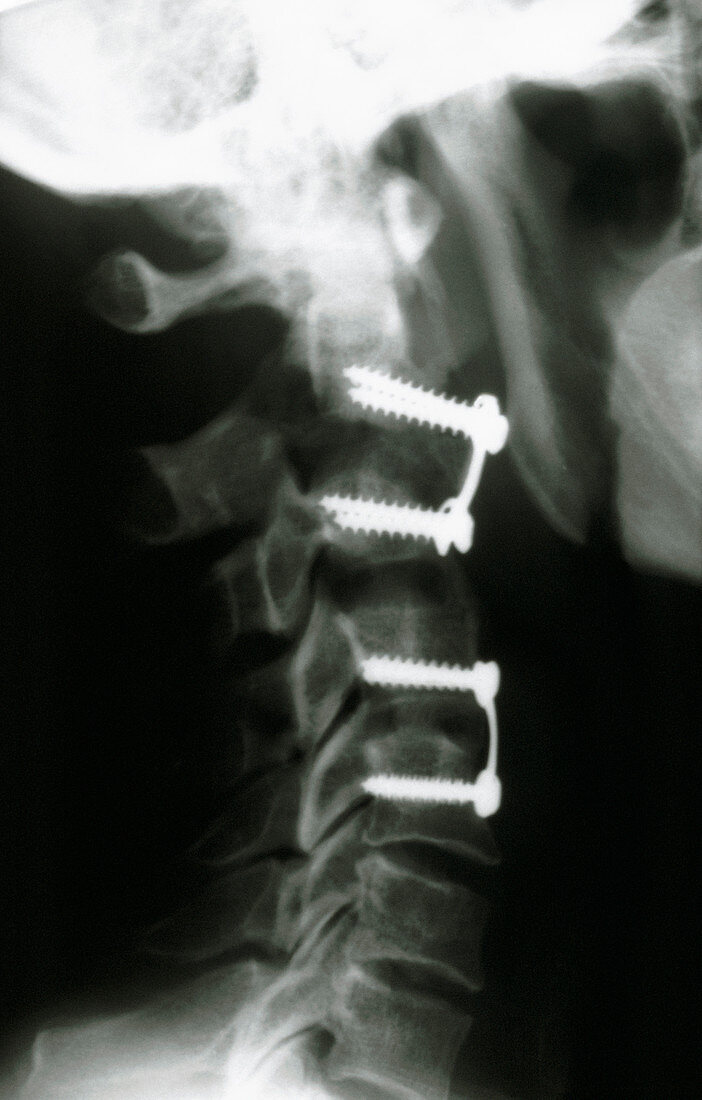 X-ray of fractured neck fixed with metal screws