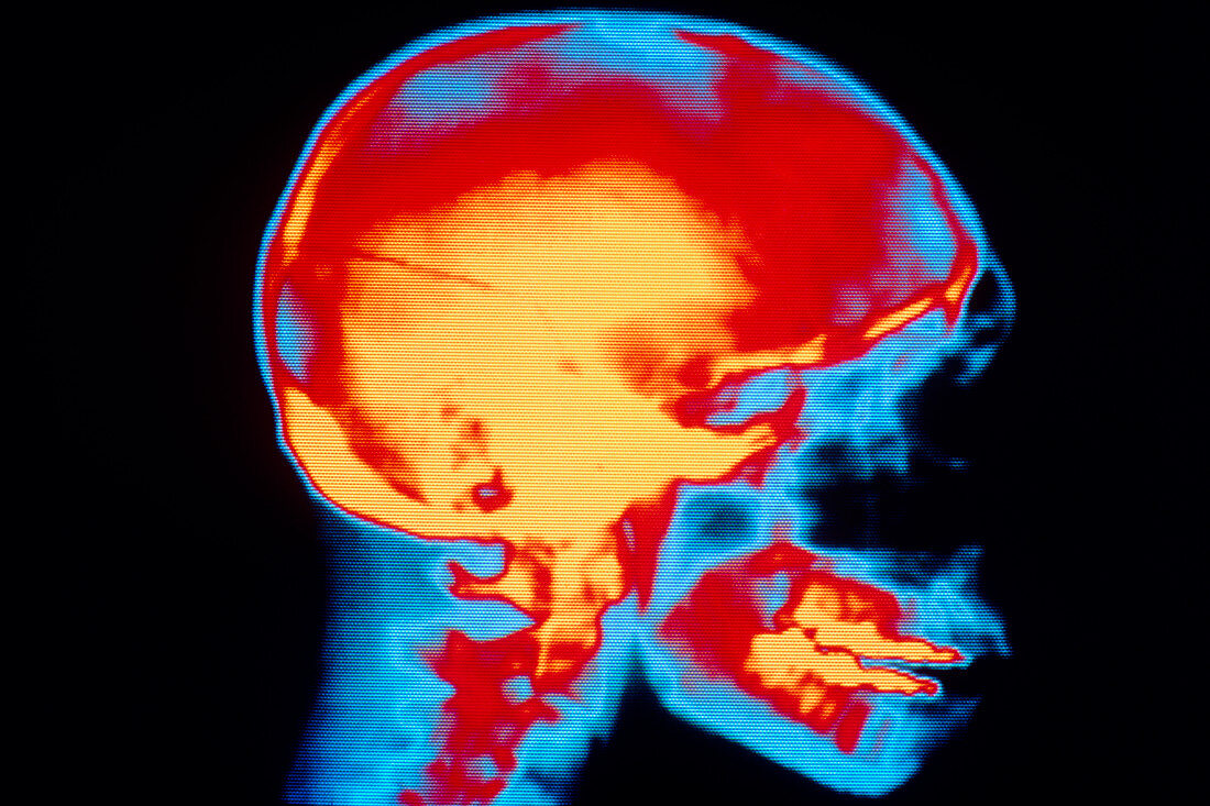 Coloured X-ray of fractured skull