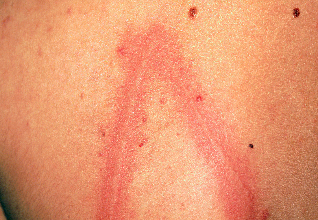 Dermatographism: urticaria on skin of a young man