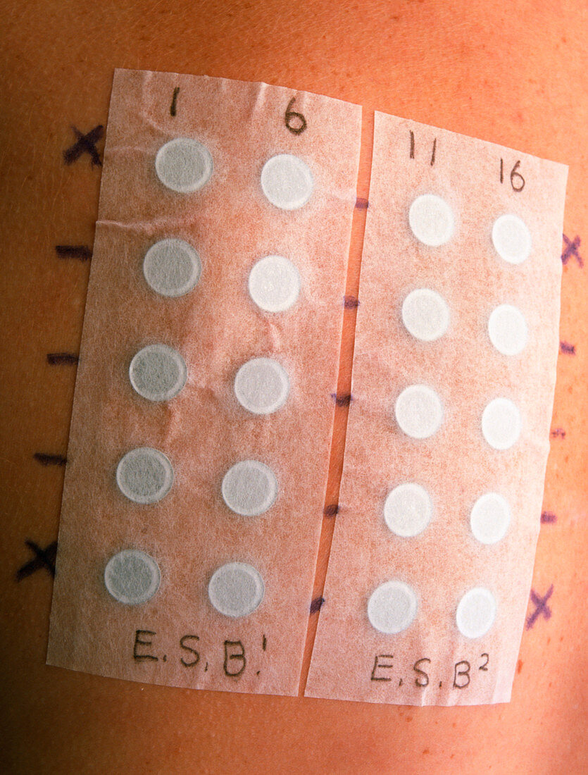 Allergy test patches on a young woman's back