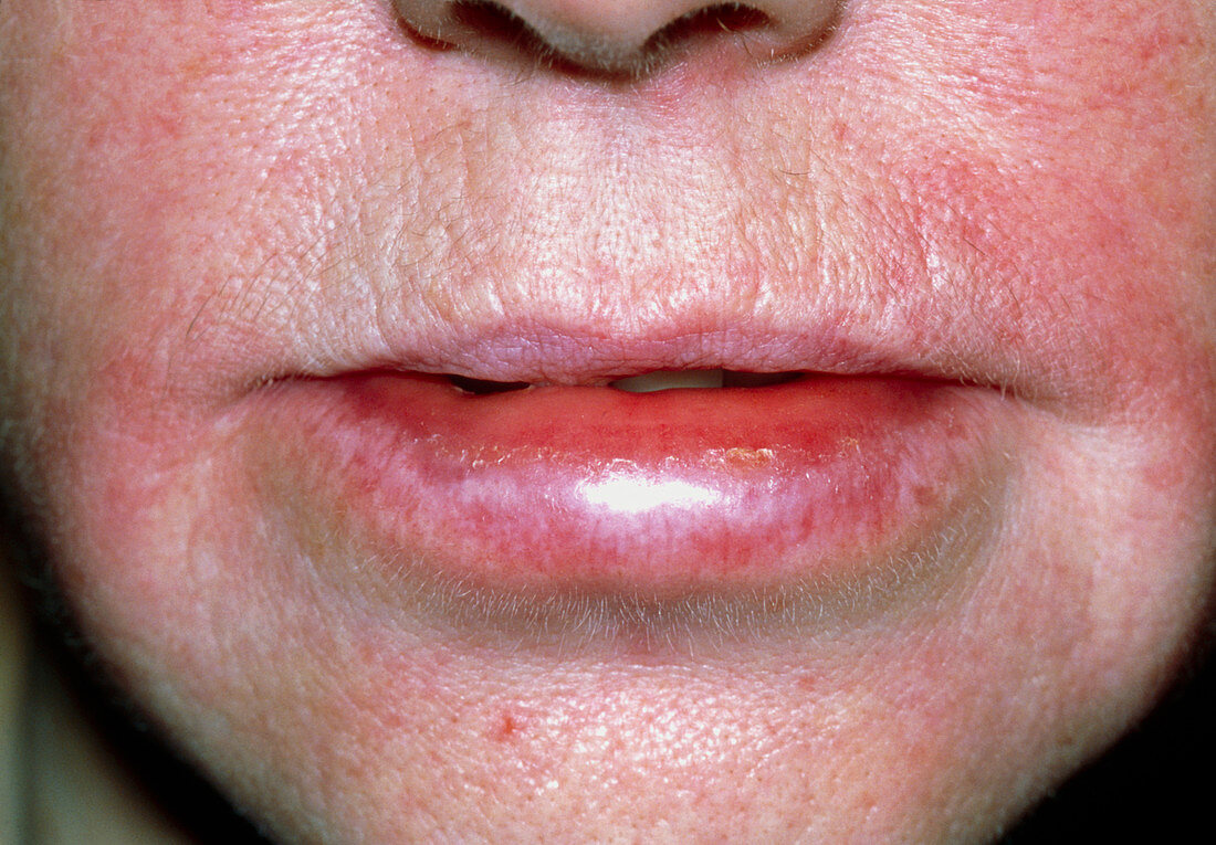 Angioedema of the lips due to an allergic reaction