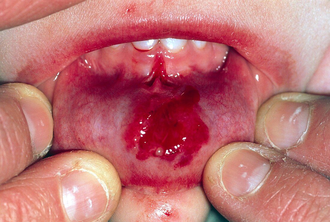 Close-up of laceration to the inside lip of child